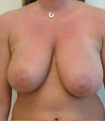 Breast Reduction