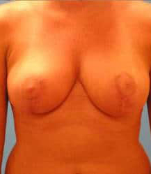 Breast Reduction