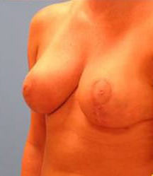 Breast Reduction