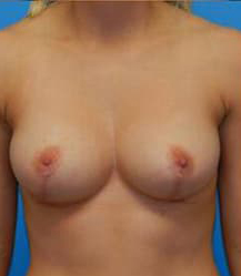 Breast Reduction