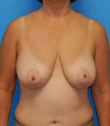 Breast Reduction