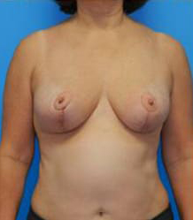 Breast Reduction