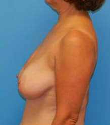 Breast Reduction