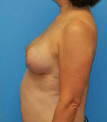 Breast Reduction