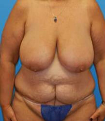 Breast Reduction