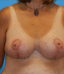 Breast Reduction