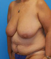 Breast Reduction