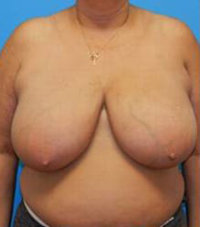 Breast Reduction