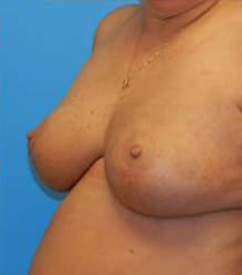 Breast Reduction