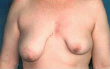 Asymmetric Breast Augmentation