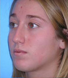 Rhinoplasty with Septoplasty