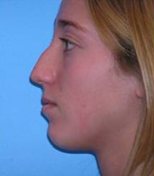 Rhinoplasty with Septoplasty