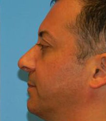 Rhinoplasty with Septoplasty