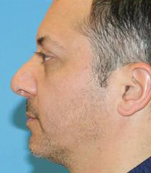 Rhinoplasty with Septoplasty