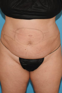 CoolSculpting® Elite