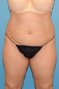 CoolSculpting® Elite