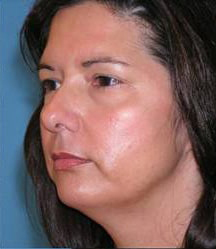 Blepharoplasty