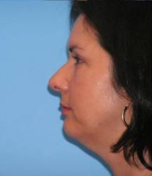 Blepharoplasty