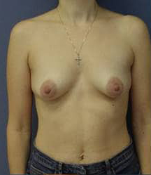 Breast Augmentation with Breast Lift