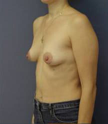 Breast Augmentation with Breast Lift