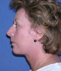 Blepharoplasty