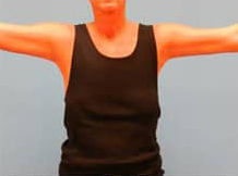 Arm Lift