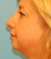 Blepharoplasty