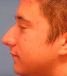 Rhinoplasty with Septoplasty