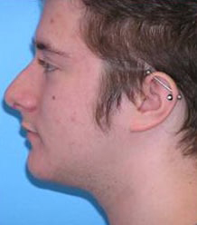 Rhinoplasty with Septoplasty