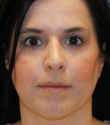 Rhinoplasty with Septoplasty