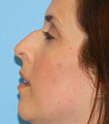 Rhinoplasty with Septoplasty