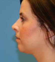 Rhinoplasty with Septoplasty