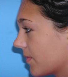 Rhinoplasty with Septoplasty