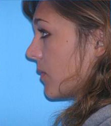 Rhinoplasty with Septoplasty