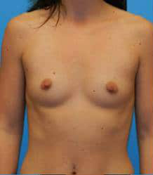 Breast Augmentation (Silicone)