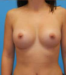 Breast Augmentation (Silicone)