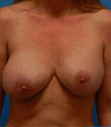 Breast Augmentation with Breast Lift