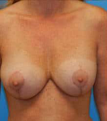 Breast Augmentation with Breast Lift