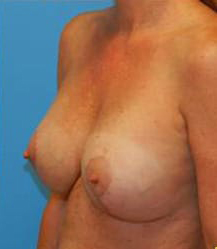 Breast Augmentation with Breast Lift