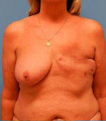 Breast Reconstruction with Tissue Expanders and Implants
