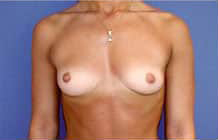 Breast Augmentation (Silicone)