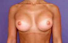 Breast Augmentation (Silicone)