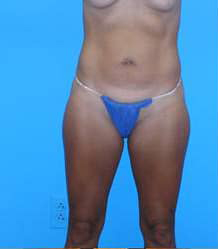 Tummy Tuck