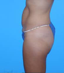 Tummy Tuck