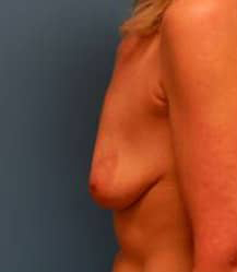 Breast Augmentation with Breast Lift