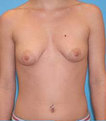 Breast Augmentation with Breast Lift