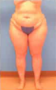 Tummy Tuck