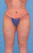 Tummy Tuck