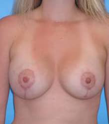 Breast Augmentation with Breast Lift