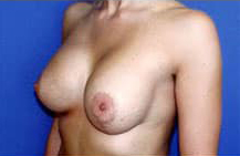 Asymmetric Breast Augmentation